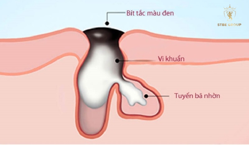 Nguyên nhân & cơ chế hình thành mụn đầu đen